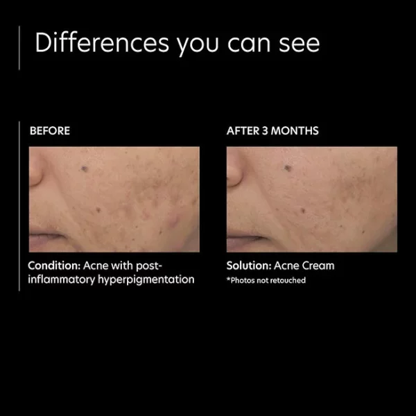 PCA SKIN Acne Cream - Image 4